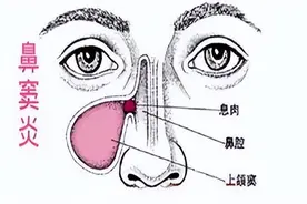 鼻窦炎是什么？它的症状和类型有哪些？图片