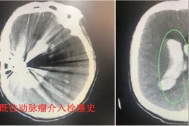 脑内畸形血管团再破裂，医生勇拆“不定时炸弹”图片