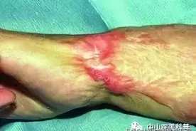 【爱美•科普】瘢痕治疗要科学图片