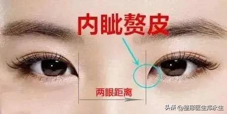 內眦赘皮是开内眼角整形最佳适应症,让深藏的粉色泪阜完美展现出来