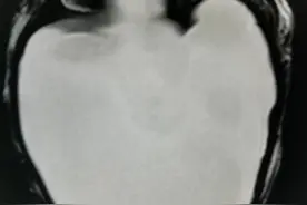 产检的重要性：一例积水型无脑畸形患儿图片