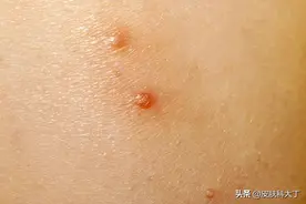 身上长皮疹，只因去游泳？图片