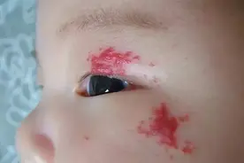 孕期3种行为容易引起宝宝胎记，准妈妈尽量避开，以防孩子自卑图片