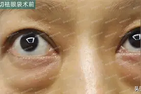 42岁做了祛眼袋手术，术后当天、1个月、3个月看看我的效果展示图片