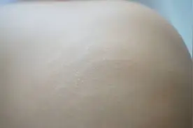 已经有了生长纹的，还会被妊娠纹double kill吗？图片