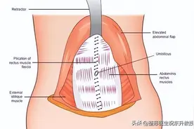 腹壁整形手术，并非在肚子上切一块肉那么简单图片