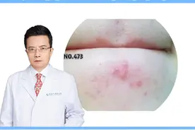 下巴长痘怎么办，教你一个简单的小方法 #科普#痘痘#痘印#甲硝唑凝胶 #壬二酸 