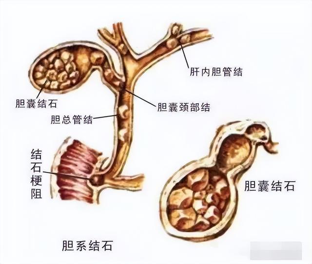 胆囊结石可不仅仅只是腹痛,这些"五花八门"的症状了解一下