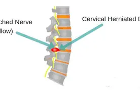5种颈椎操锻炼方法图片大全，颈椎病最佳自我治疗动作图片