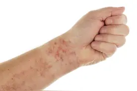 反复发作的紫癜是不是一次比一次严重？图片