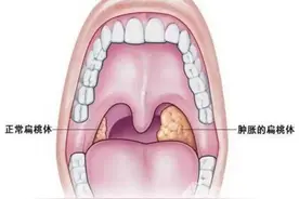 扁桃体、腺样体切除？到底什么情况下必须做？一文说清图片