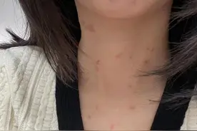 患上扁平疣早早治，才能美美过夏天图片