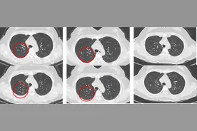 这样的肺结节，切了还不如不切！你是这种情况吗？图片