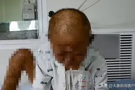 13岁男孩患怪病皮肤发黑浑身奇痒图片