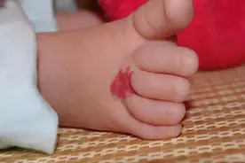 「家长注意」别把婴幼儿身上的血管瘤当胎记！3招让你快速鉴别图片
