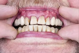 掉牙和寿命有关？60岁后有多少颗牙齿算正常？看看你合格吗图片