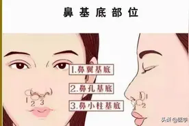 做了隆鼻看起来还是不立体，是不是鼻基底凹陷的锅？图片