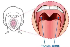欧阳医生谈谈急性扁桃体炎的病因和防治图片