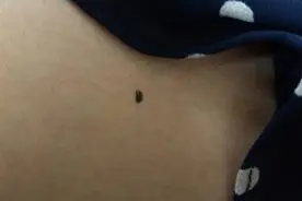 身上有3种类型的痣应及时处理，以防不是良性痣图片