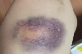 如果你莫名出现紫色瘀斑，是血液病还是别的问题呢？图片