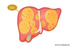 世上本无脂肪肝，无非是痰湿太重，一个中成药，专克脂肪肝图片