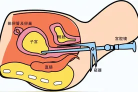 “小镜头，大健康”——带你了解妇科“神器”宫腔镜图片