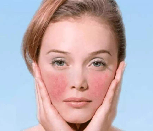 面部潮红,脱皮,肿胀,脸上痒得像子在脸上爬,这是过敏吗?