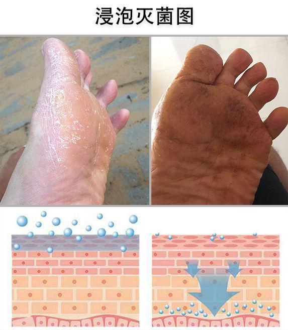 角化行脚气