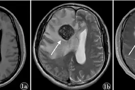 影像诊断笔记-脑包虫病图片