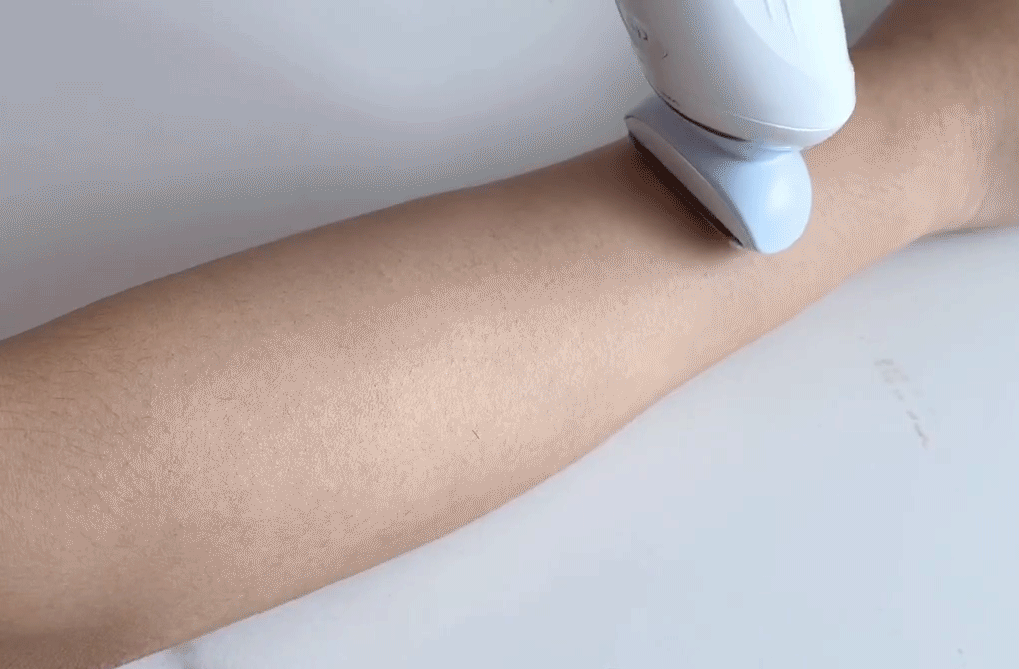 冰点脱毛以后可以擦身体乳吗