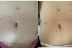 便秘（排便困难）的外科根治性治疗图片
