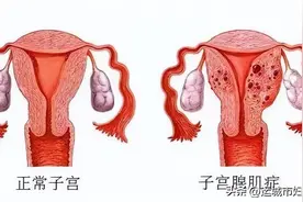 科普｜带你认识困扰女性的子宫腺肌症图片