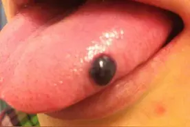 嘴里长“血疱”以为是吃饭不小心咬到导致的？99%的人都误会了！图片