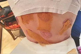 男子拔火罐被烫伤，只赔付1000多元？哈尔滨一沐一善洗浴：建议走司法程序图片