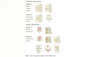 胸腰椎骨折AO分型与TLICS、载荷分享评分图片