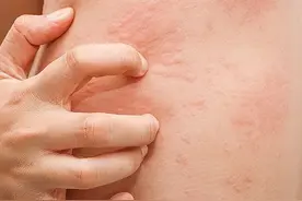 不要错把艾滋病当皮肤病，皮肤出现3种情况，或是艾滋发出的信号图片