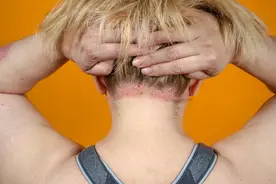 头皮上，经常长疙瘩和脓包，是怎么了？是病吗？医生的建议听一听图片