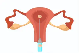 人工授精是怎么个授精法？图片