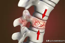 老年人腰部疼痛，常见于压缩骨折，该如何应对？给您讲清利弊图片