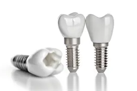 植得口腔王茜：种植牙的常见“坑”，你都踩了吗？图片