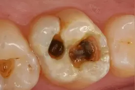 蛀牙多年也没疼，可以不管？医生：拖下去，补牙、根管都救不了！图片