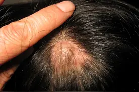 头皮上的小疙瘩和脓包，到底是什么？或是皮肤出现了5种“异常”图片