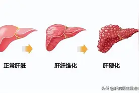 肝纤维化多久变成肝硬化？如何治？能否逆转？一文告诉你图片