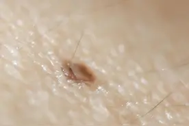 知名歌手因病去世，罪魁祸首“黑色素瘤”是什么？图片