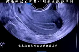超声科：黄体对，还是宫外孕？图片