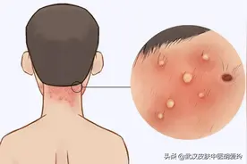 脖子后面长痘痘又痛又痒图片