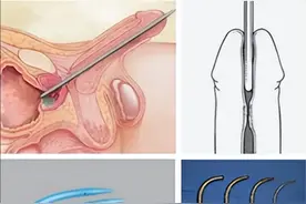 排尿困难，尿道狭窄的那些事！图片