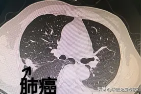 2味平凡的中药，却是治疗肺癌的基本用药！图片
