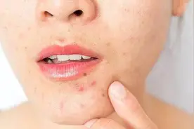 痤疮和毛囊炎如何区分？看皮肤科医生怎么说图片