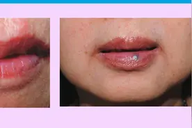 嘴唇上的黑点，挤破后，竟然出了一手血...图片